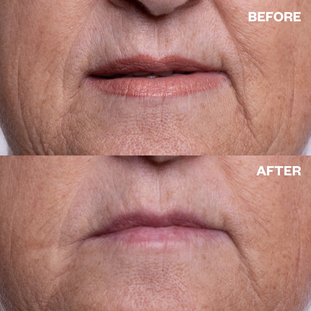 Mouth & Lip Wrinkle Patch